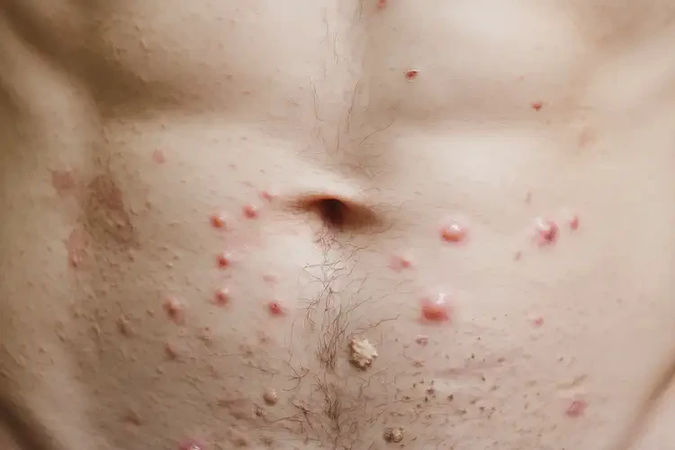 男性肚子經(jīng)常長濕疹不管它會自己痊愈嗎(圖4)