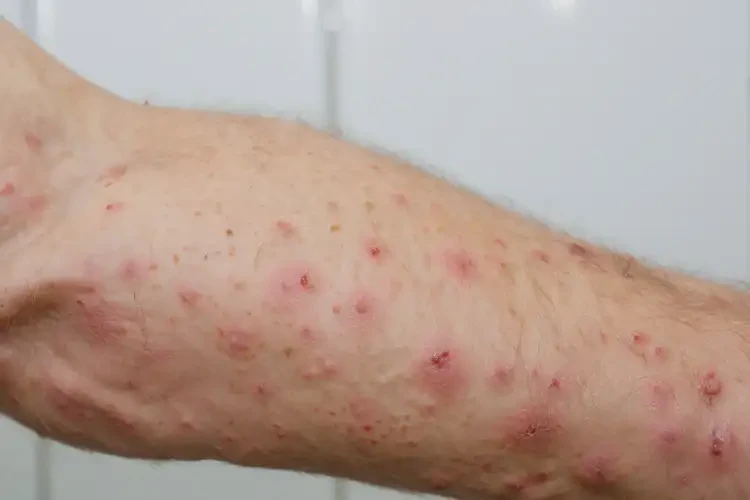 老人手臂出現(xiàn)濕疹可不可以徹底自愈(圖4)