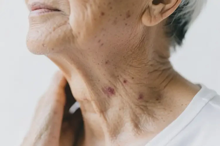 老人脖子上偶爾起濕疹能徹底自愈嗎(圖3)
