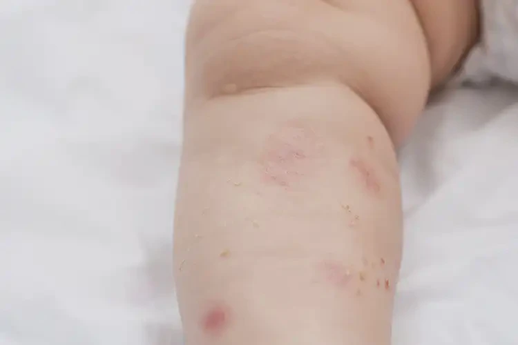 嬰兒大腿容易起濕疹可以徹底自愈嗎(圖4)