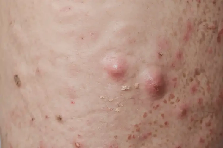 男人大腿上容易長(zhǎng)濕疹能不能徹底自愈(圖4)