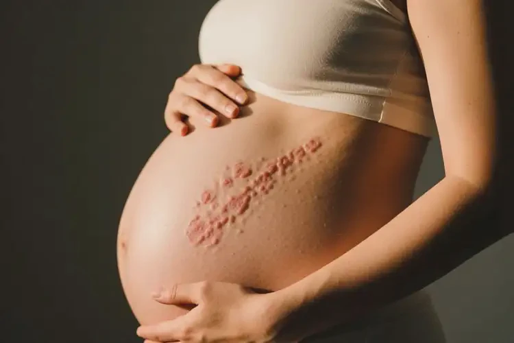 产妇脖子上有湿疹可不可以彻底自愈(图1)