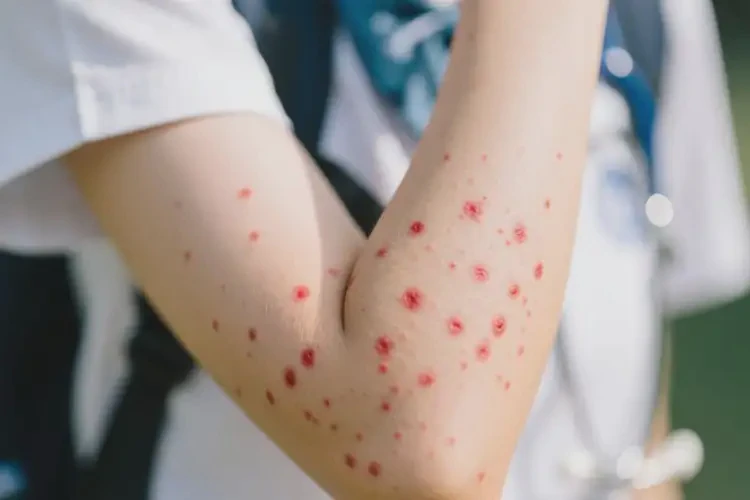 大學生手臂偶爾起濕疹不管它會自己痊愈嗎(圖4)