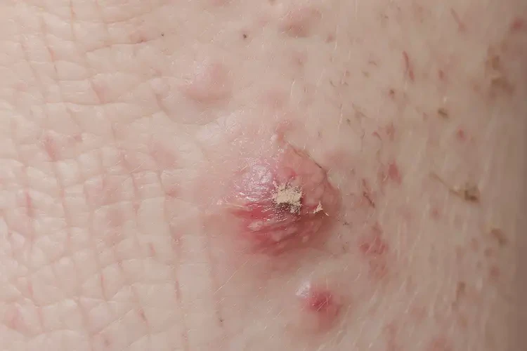 女生屁股上起濕疹可不可以徹底自愈(圖3)