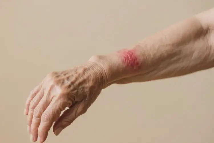 老年人手臂出现湿疹可以彻底自愈吗(图4)