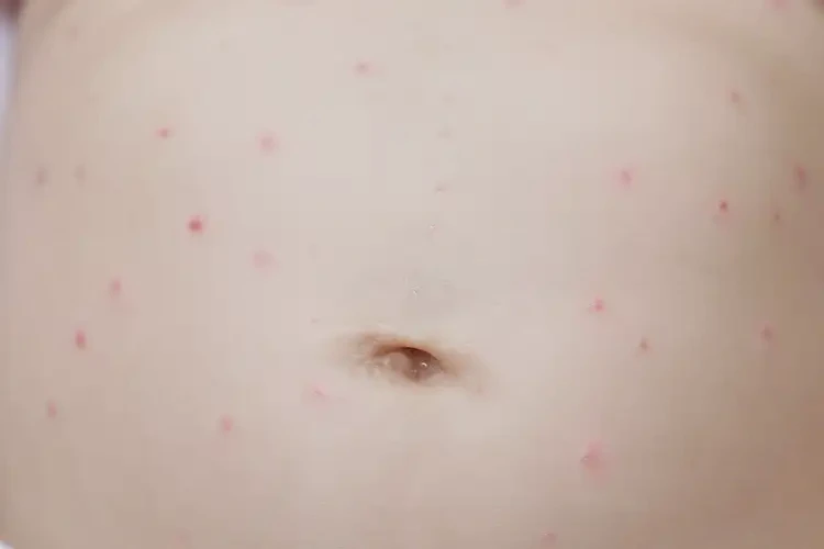 嬰兒肚子有濕疹可以徹底自愈嗎(圖4)