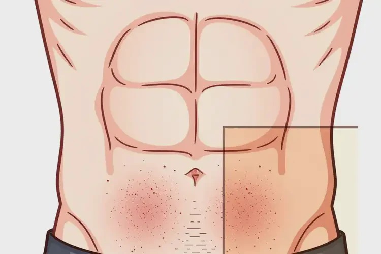 青年人肚子上偶爾長濕疹能不能徹底自愈(圖3)