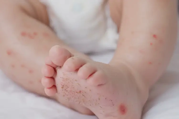 寶寶腳上偶爾起濕疹能夠徹底治愈嗎(圖4)