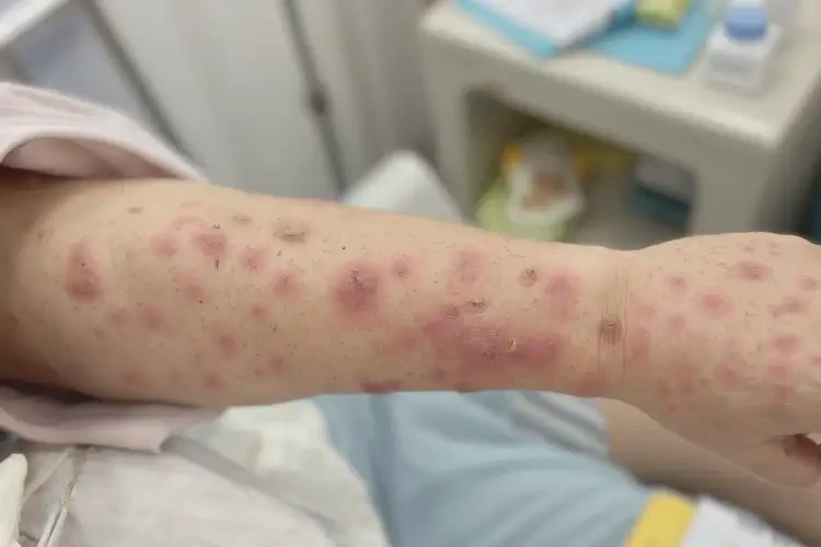 產(chǎn)婦手臂出現(xiàn)濕疹不管它會(huì)自己自愈嗎(圖4)