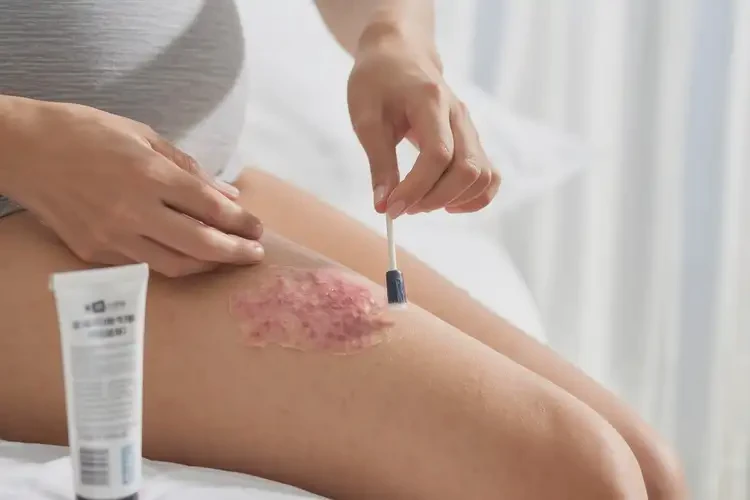 產(chǎn)婦大腿經(jīng)常起濕疹可不可以徹底自愈(圖3)