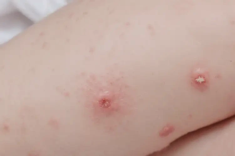 寶寶大腿起濕疹不管它會自己痊愈嗎(圖4)