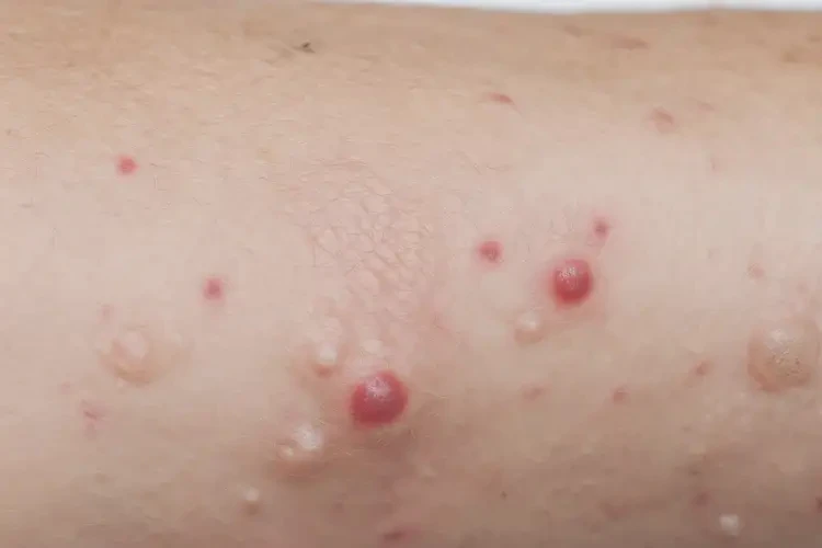 大學(xué)生手臂上出現(xiàn)濕疹可以徹底自愈嗎(圖4)