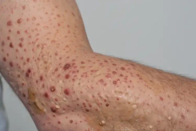 幼兒小腿上出現(xiàn)濕疹不管它會(huì)自己好嗎(圖2)