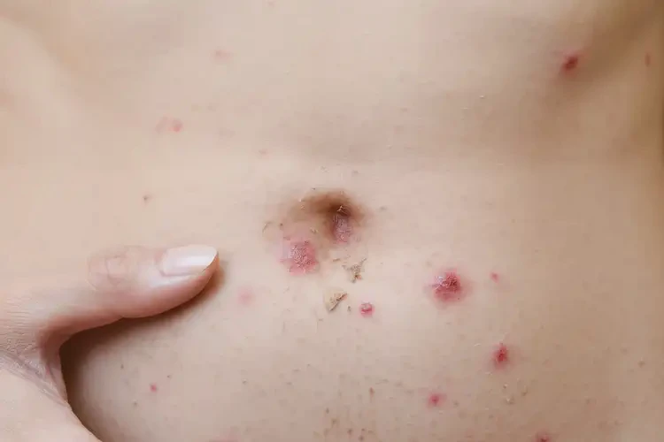 女性肚子上有濕疹不管它會自己痊愈嗎(圖4)