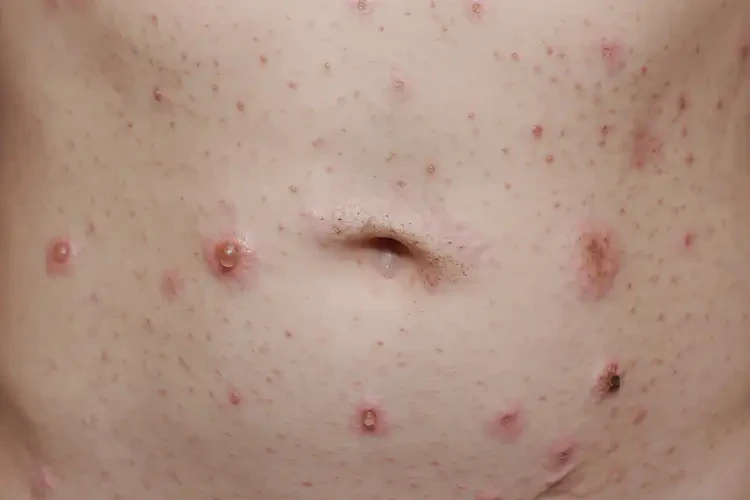 青少年肚子經(jīng)常起濕疹能不能徹底自愈(圖4)