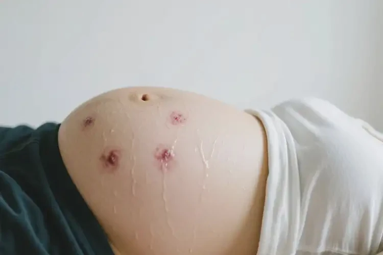 孕婦肚子上長(zhǎng)濕疹能徹底自愈嗎(圖2)