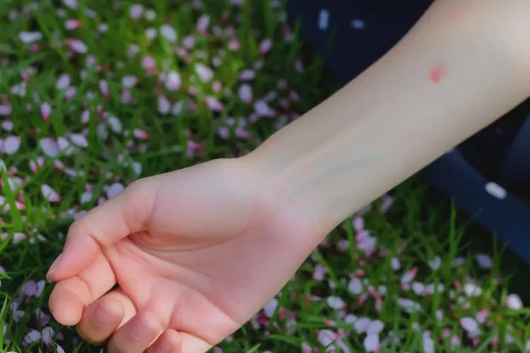 青少年手臂上長濕疹能不能徹底自愈(圖3)