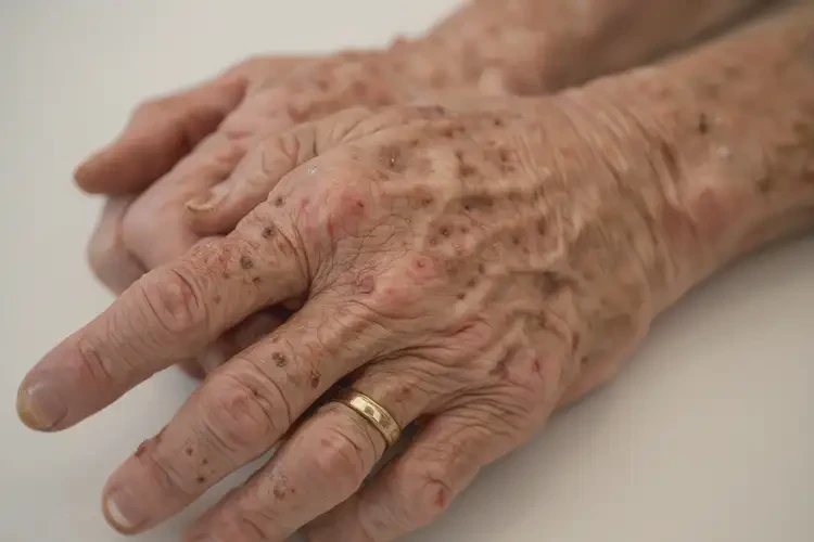 老年人手上出濕疹不管它會(huì)自己痊愈嗎(圖3)