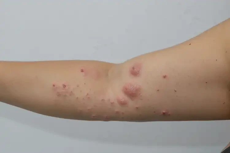 孕婦手臂出現(xiàn)濕疹不管它會自己好嗎(圖4)