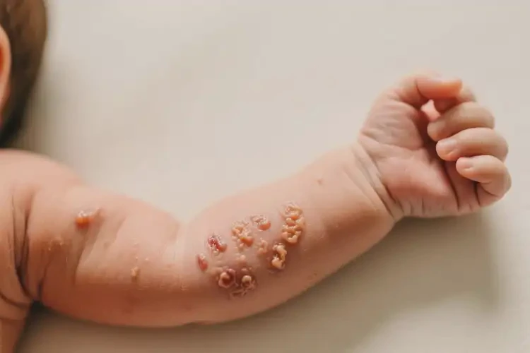 新生兒手臂上出現(xiàn)濕疹不管它會(huì)自己好嗎(圖3)