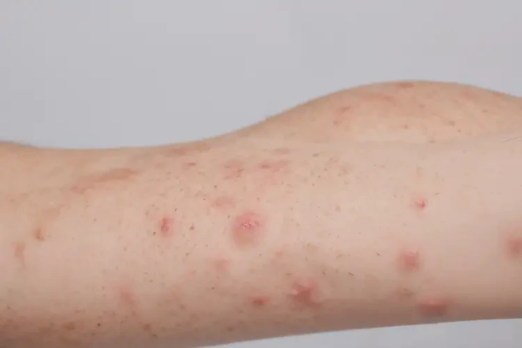 大學(xué)生手臂上偶爾長濕疹不管它會自己痊愈嗎(圖4)