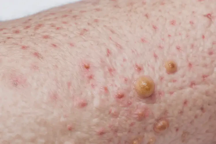 孩子腳上偶爾起濕疹能靠自己自愈嗎(圖3)