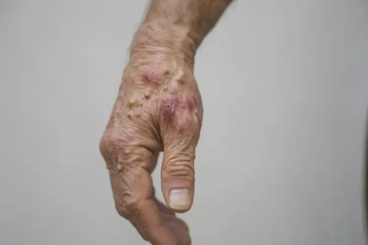 老人手上容易長(zhǎng)濕疹可不可以徹底自愈(圖4)