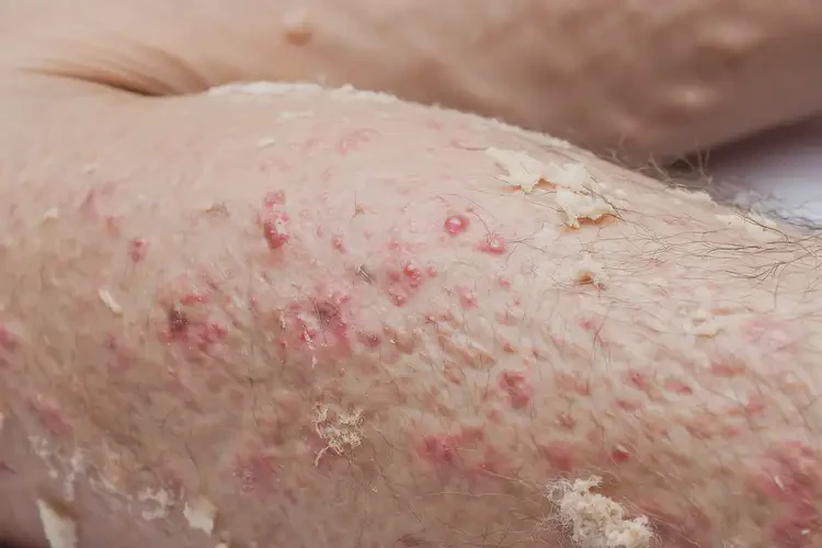 男性四肢經(jīng)常長濕疹能靠自己自愈嗎(圖4)