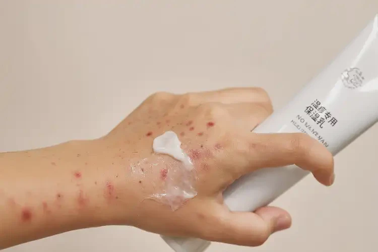 青少年手上容易长湿疹不管它会自己痊愈吗(图3)
