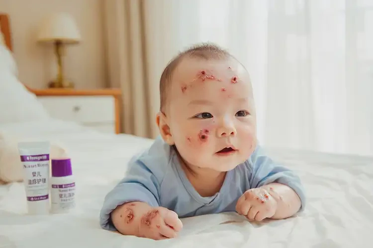 孩子屁股容易長濕疹能徹底自愈嗎(圖4)