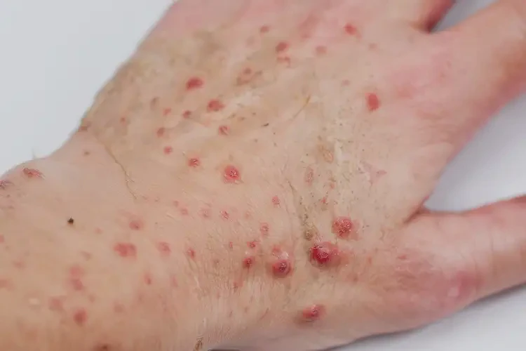 青少年手上長(zhǎng)濕疹可以徹底自愈嗎(圖4)