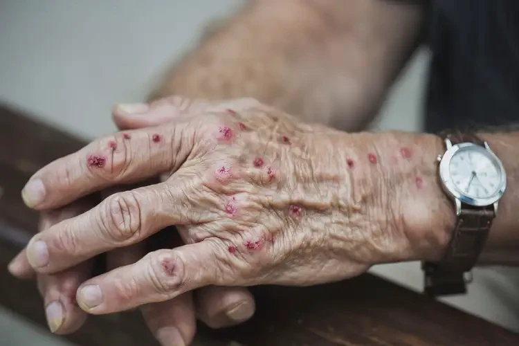 高齡老人手上起濕疹能不能徹底自愈(圖4)