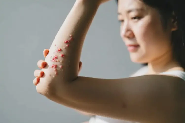 孕妇手臂上起湿疹可不可以彻底自愈(图2)