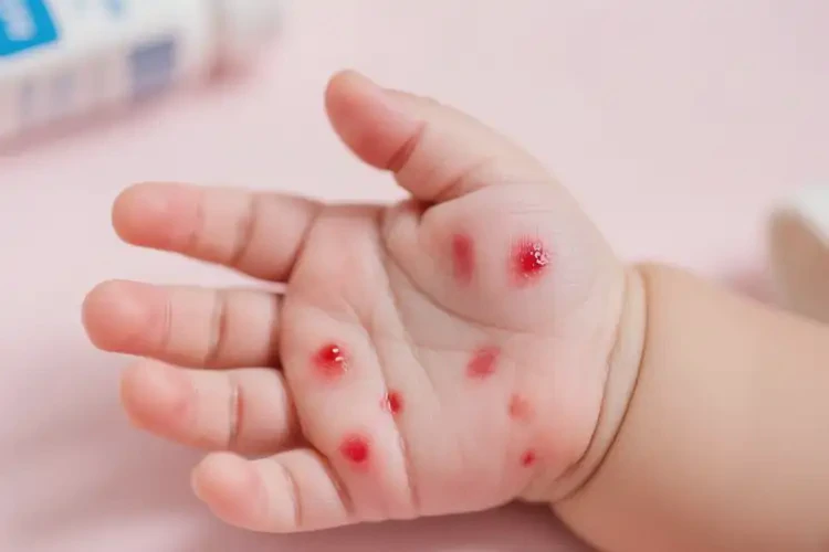嬰兒手上長濕疹不管它會自己自愈嗎(圖3)