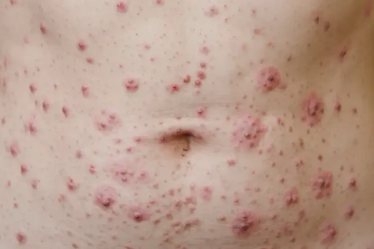 女性肚子上起濕疹能徹底自愈嗎(圖4)