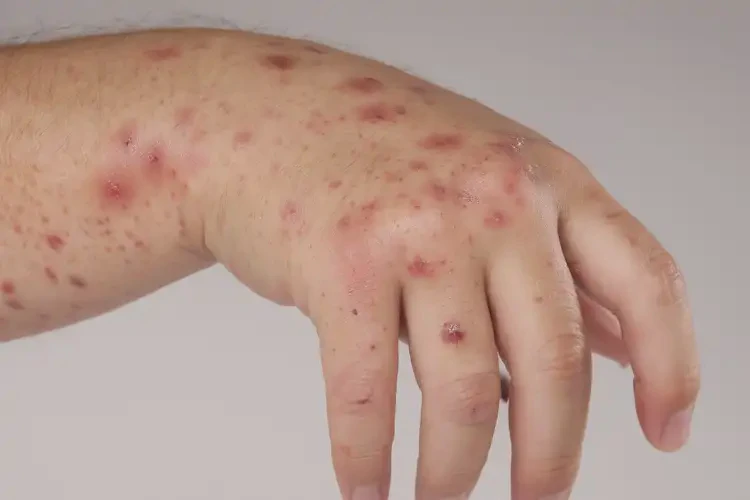 中學(xué)生手上容易起濕疹能徹底自愈嗎(圖4)
