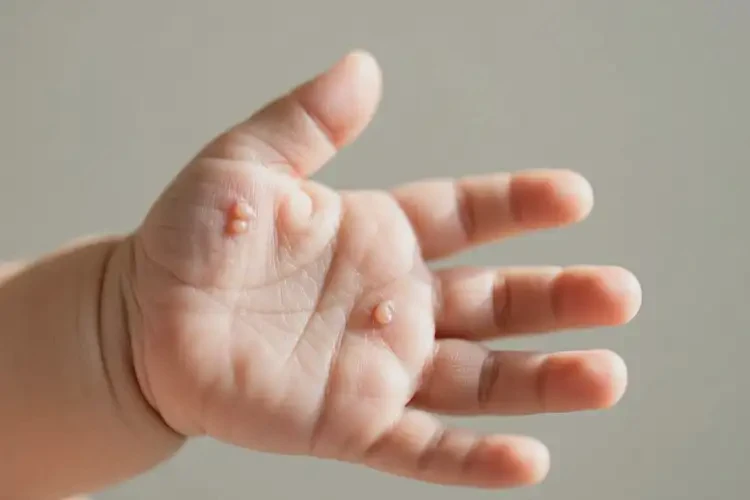 嬰幼兒身上起濕疹不管它會自己自愈嗎(圖4)