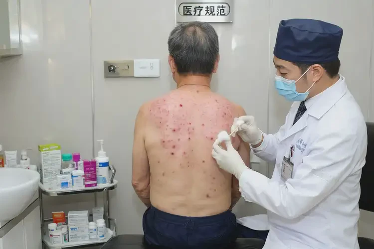 男人全身經(jīng)常長濕疹能徹底自愈嗎(圖3)