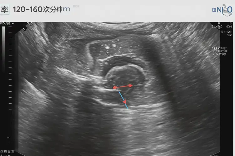 懷孕第20周胎心101正常嗎(圖4)