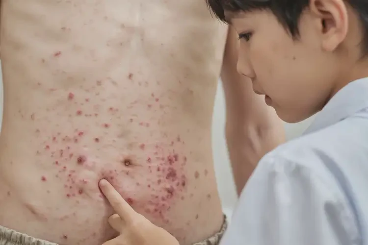 青少年肚子上容易起濕疹能徹底自愈嗎(圖4)