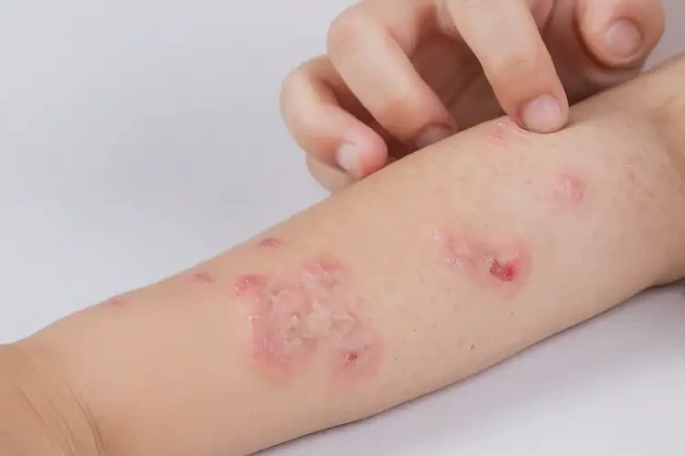 少兒手臂偶爾長(zhǎng)濕疹能夠徹底治愈嗎(圖4)