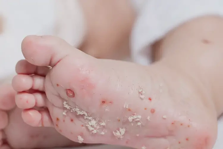 宝宝脚上经常长湿疹不管它会自己痊愈吗(图4)