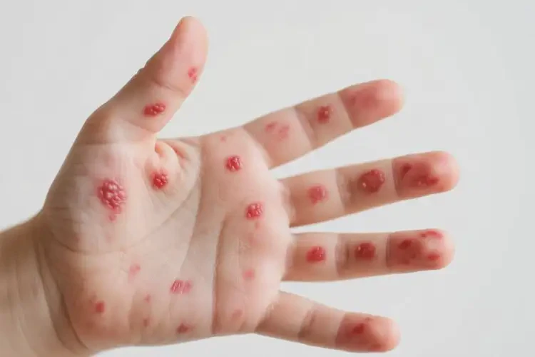 小孩手上經(jīng)常長濕疹可以徹底自愈嗎(圖4)