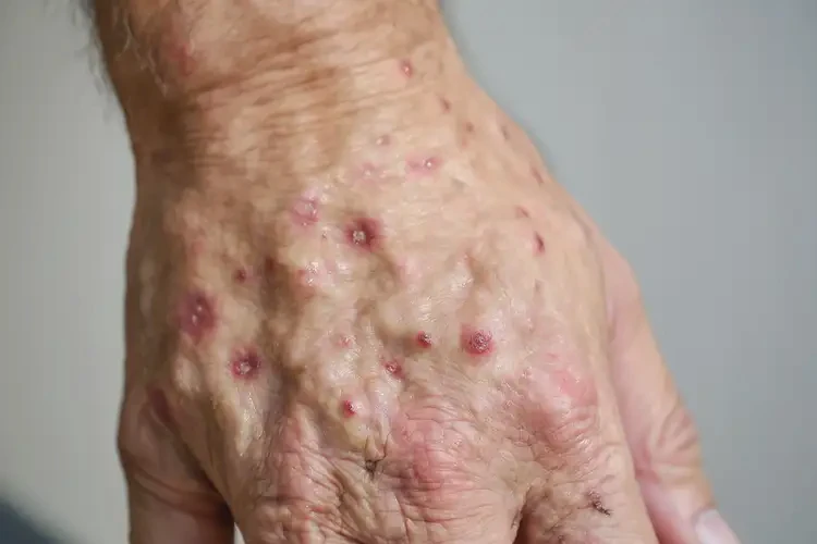 男性手上容易長濕疹可以徹底自愈嗎(圖4)