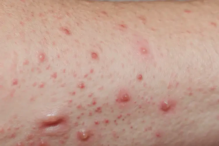 幼兒小腿上出現(xiàn)濕疹不管它會(huì)自己好嗎(圖3)