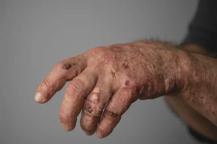 大學(xué)生手上長(zhǎng)濕疹能徹底自愈嗎(圖3)