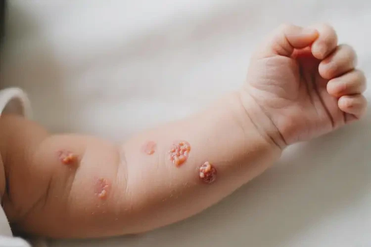 新生兒手臂上出現(xiàn)濕疹不管它會(huì)自己好嗎(圖1)