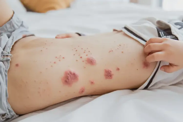 小兒肚子上容易長(zhǎng)濕疹不管它會(huì)自己自愈嗎(圖4)