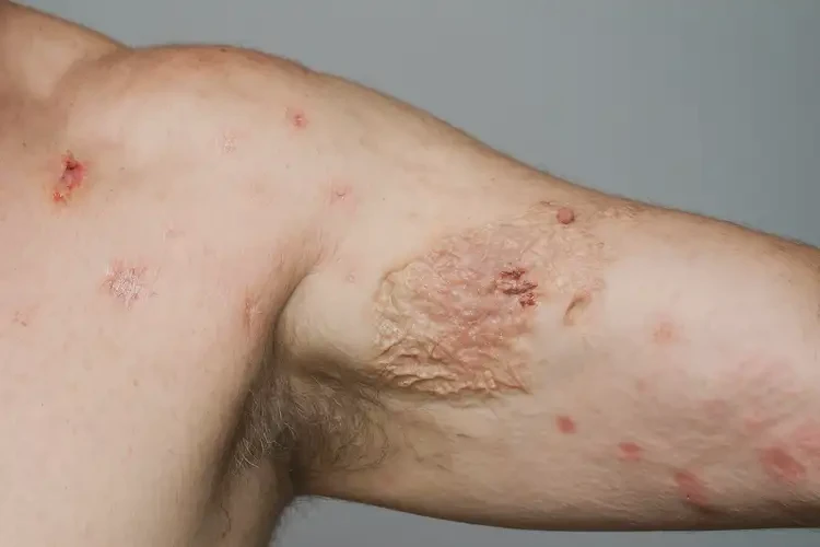 女人腳上容易起濕疹不管它會(huì)自己痊愈嗎(圖3)