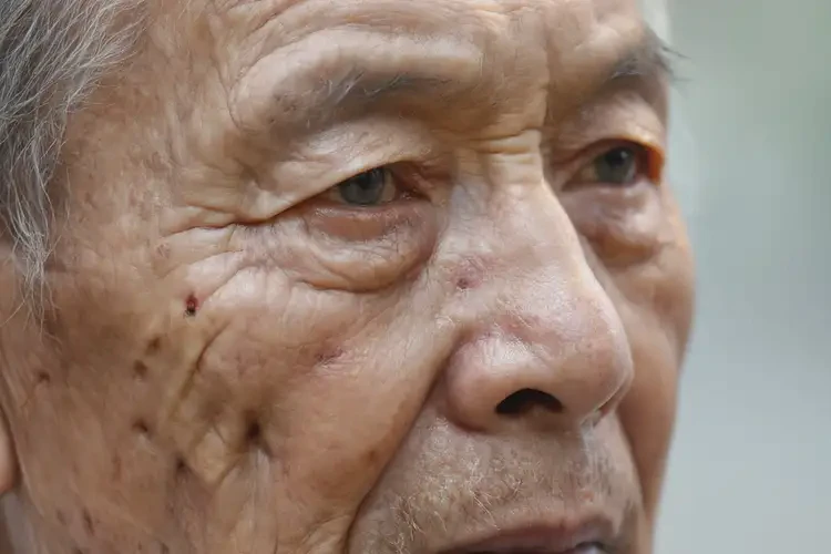 老年人身上容易起濕疹能靠自己自愈嗎(圖4)